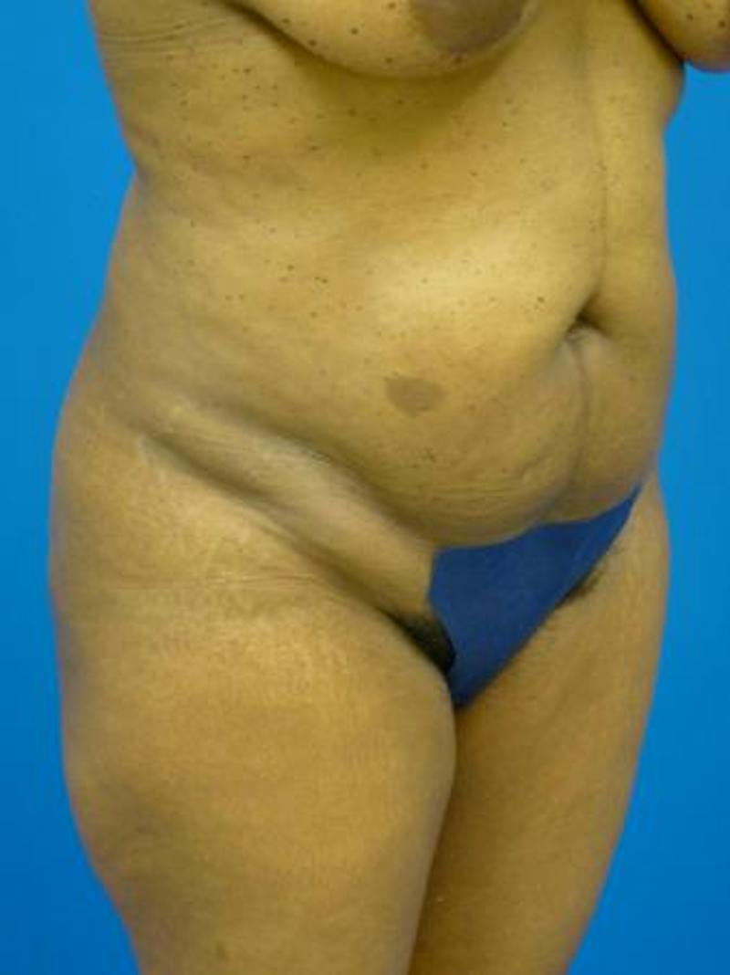 Liposuction Before & After Gallery - Patient 340904 - Image 1