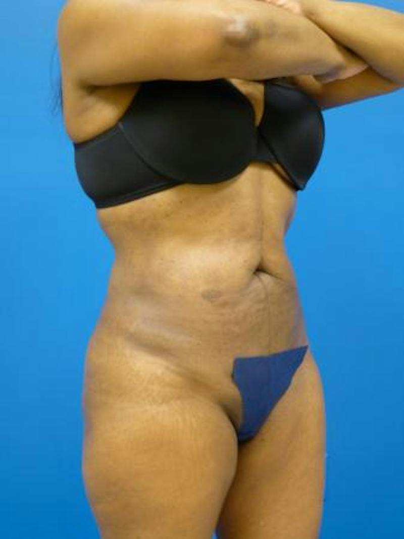 Liposuction Before & After Gallery - Patient 340904 - Image 2