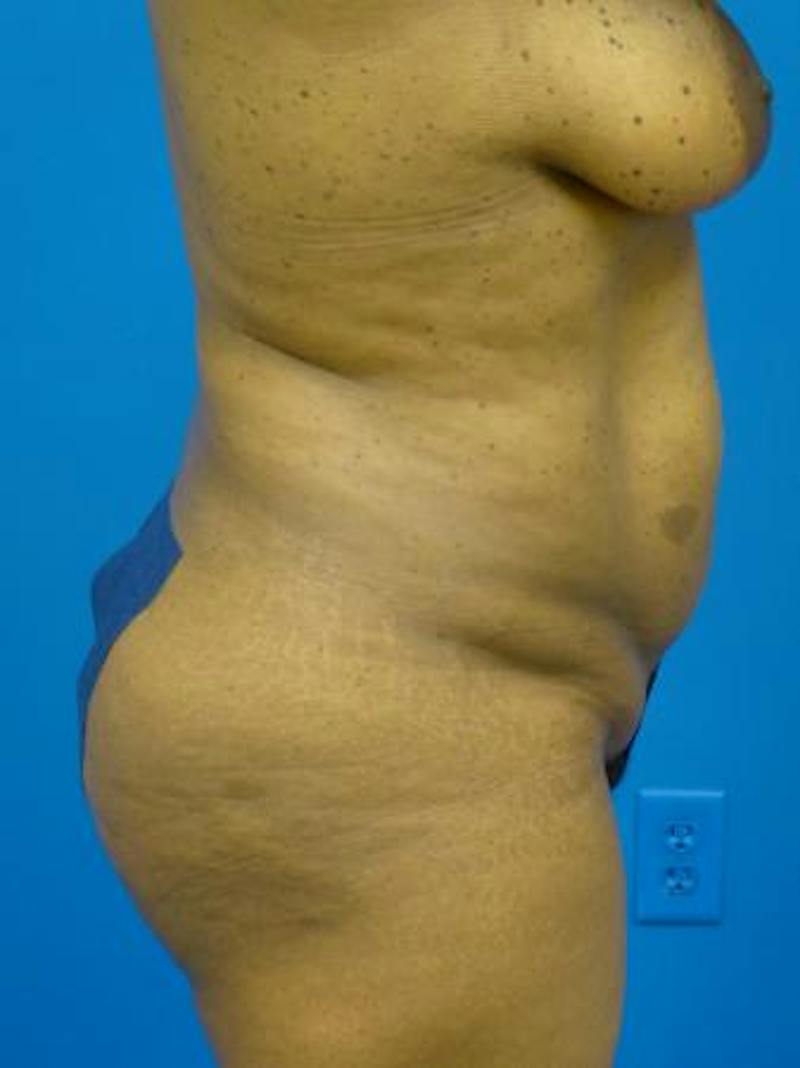 Liposuction Before & After Gallery - Patient 340904 - Image 3
