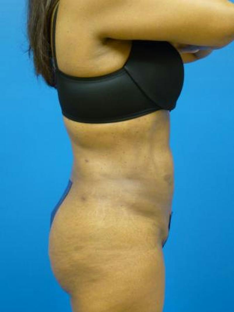 Liposuction Before & After Gallery - Patient 340904 - Image 4