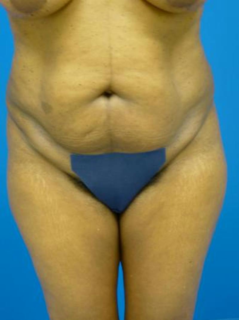 Liposuction Before & After Gallery - Patient 340904 - Image 5