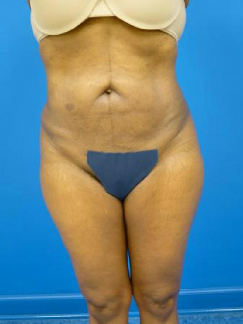 Liposuction Before & After Gallery - Patient 340904 - Image 6