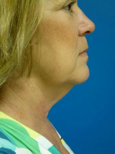 Liposuction Before & After Gallery - Patient 324398 - Image 1