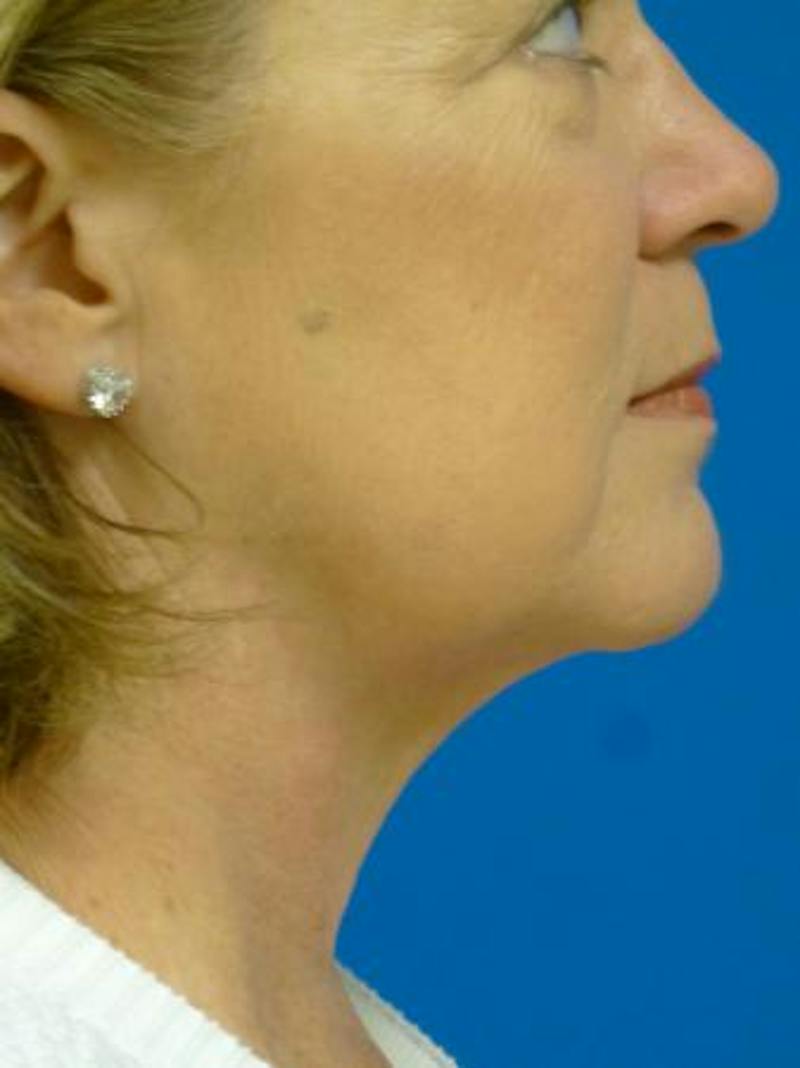 Liposuction Before & After Gallery - Patient 324398 - Image 2