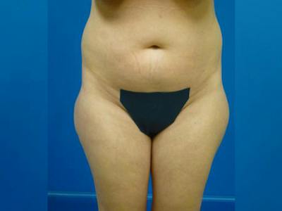 Liposuction Before & After Gallery - Patient 327007 - Image 1