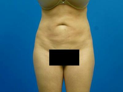 Liposuction Before & After Gallery - Patient 327007 - Image 2