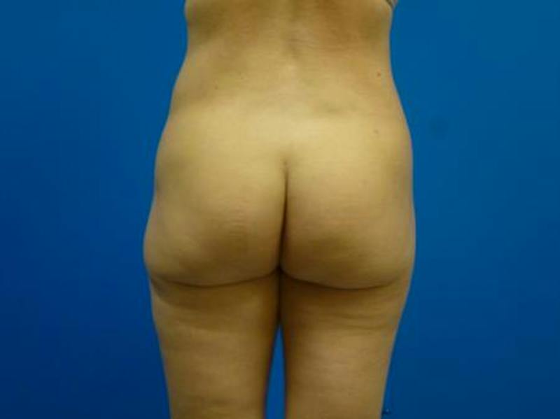 Liposuction Before & After Gallery - Patient 327007 - Image 4