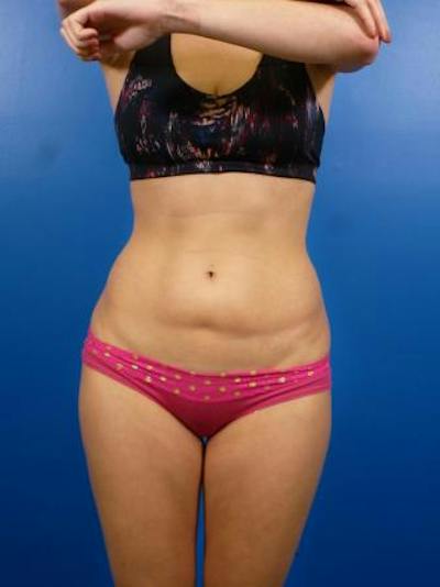 Liposuction Before & After Gallery - Patient 290949 - Image 1