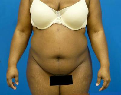 Liposuction Before & After Gallery - Patient 301979 - Image 1