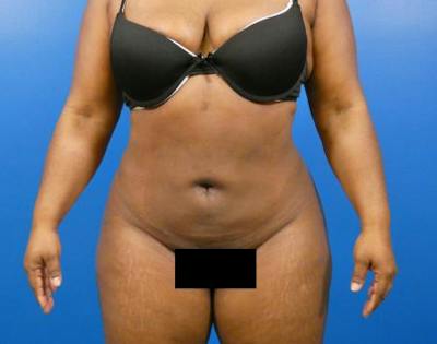 Liposuction Before & After Gallery - Patient 301979 - Image 2