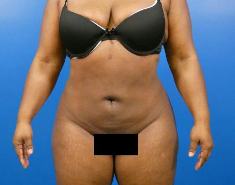Liposuction Before & After Gallery - Patient 301979 - Image 2