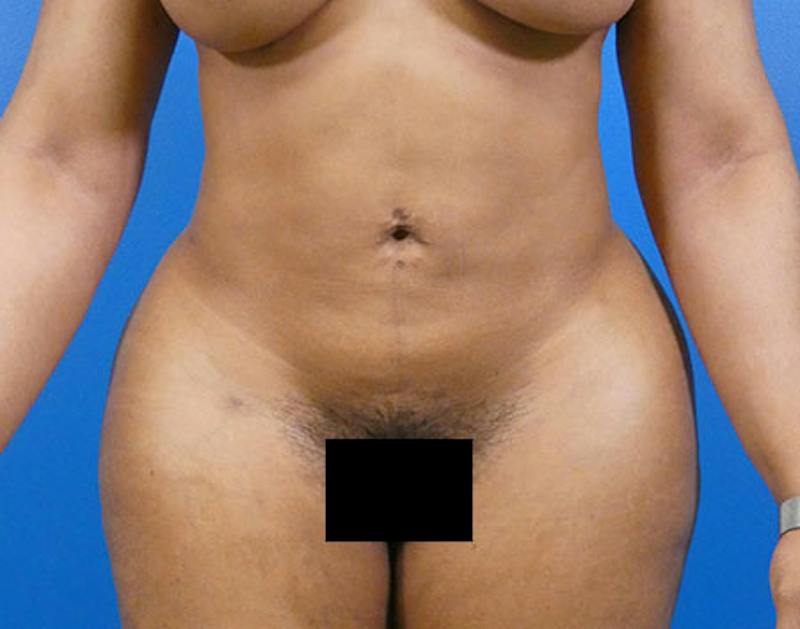 Liposuction Before & After Gallery - Patient 153611 - Image 2