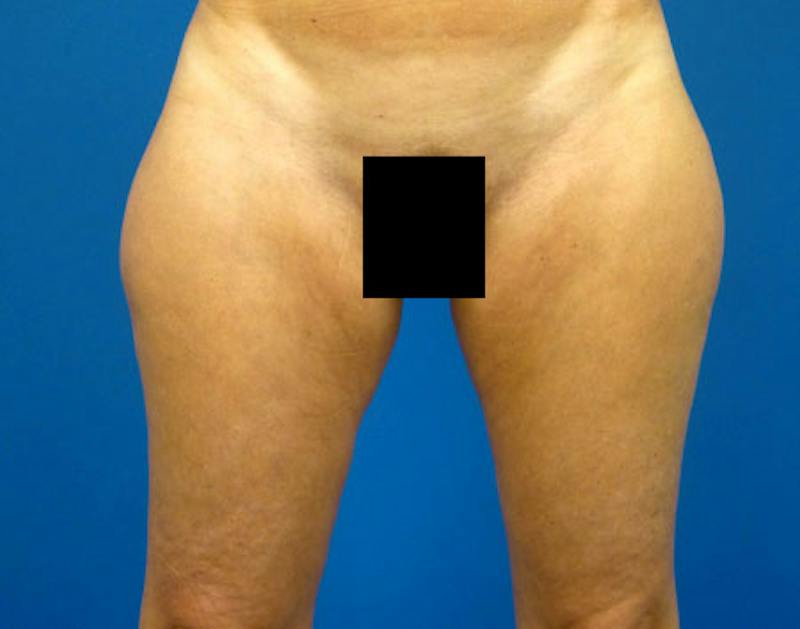 Liposuction Before & After Gallery - Patient 469480 - Image 1
