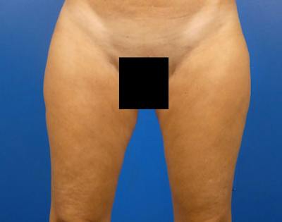 Liposuction Before & After Gallery - Patient 469480 - Image 2
