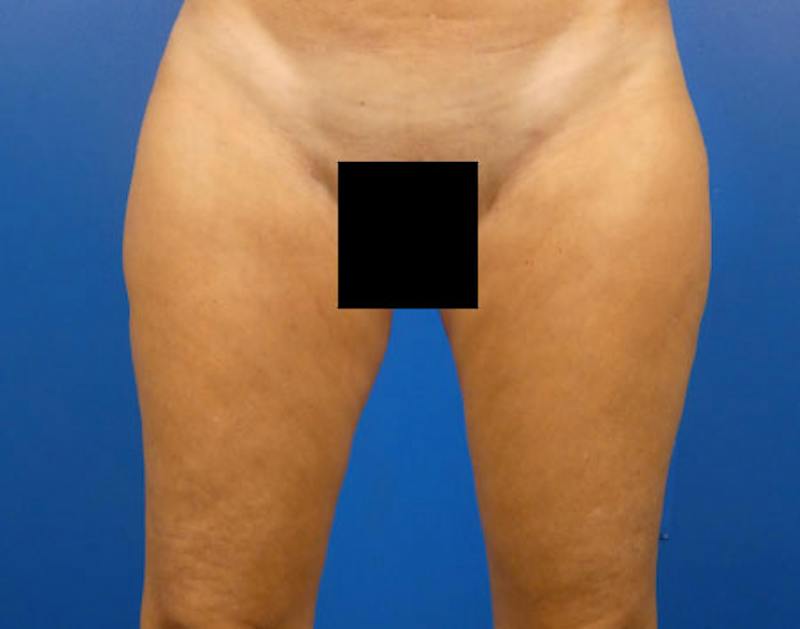 Liposuction Before & After Gallery - Patient 469480 - Image 2