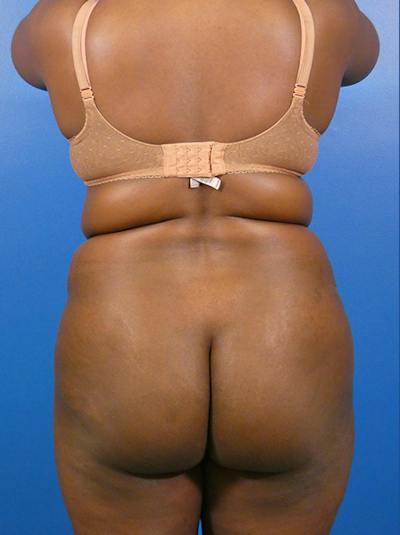 Liposuction Before & After Gallery - Patient 309187 - Image 1