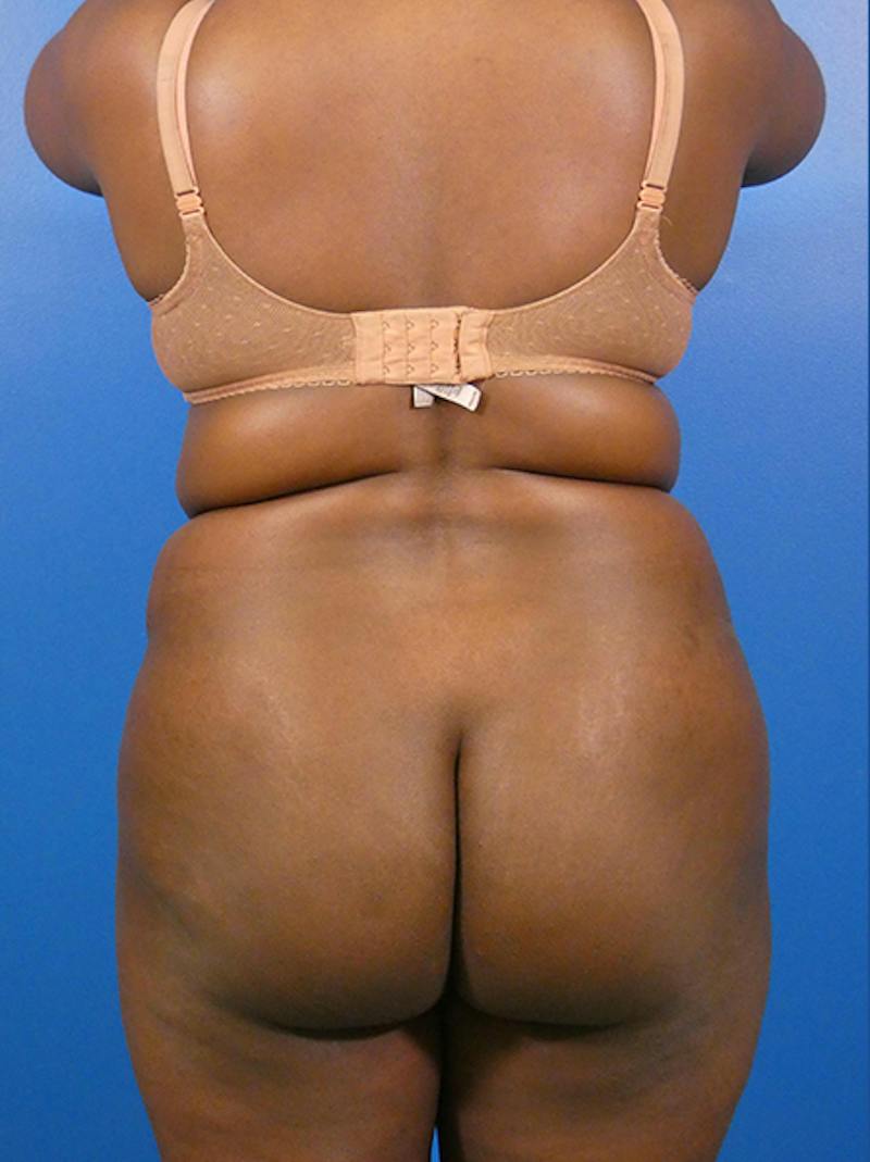 Liposuction Before & After Gallery - Patient 309187 - Image 1