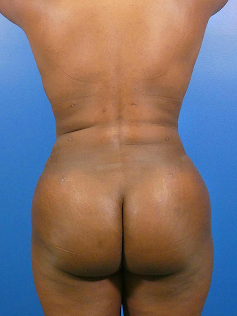 Liposuction Before & After Gallery - Patient 309187 - Image 2
