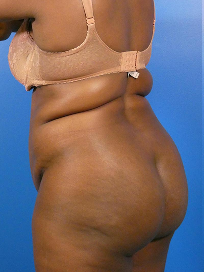 Liposuction Before & After Gallery - Patient 309187 - Image 3