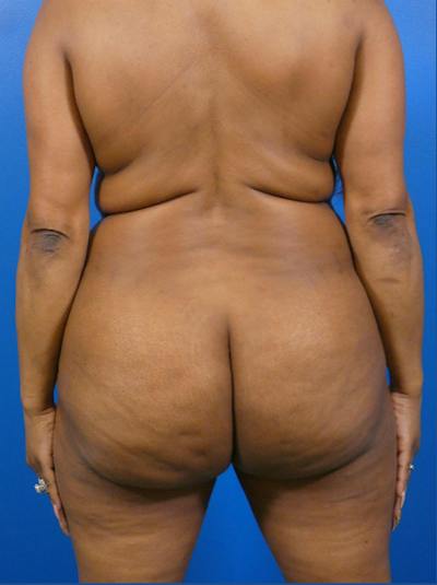 Liposuction Before & After Gallery - Patient 396376 - Image 1