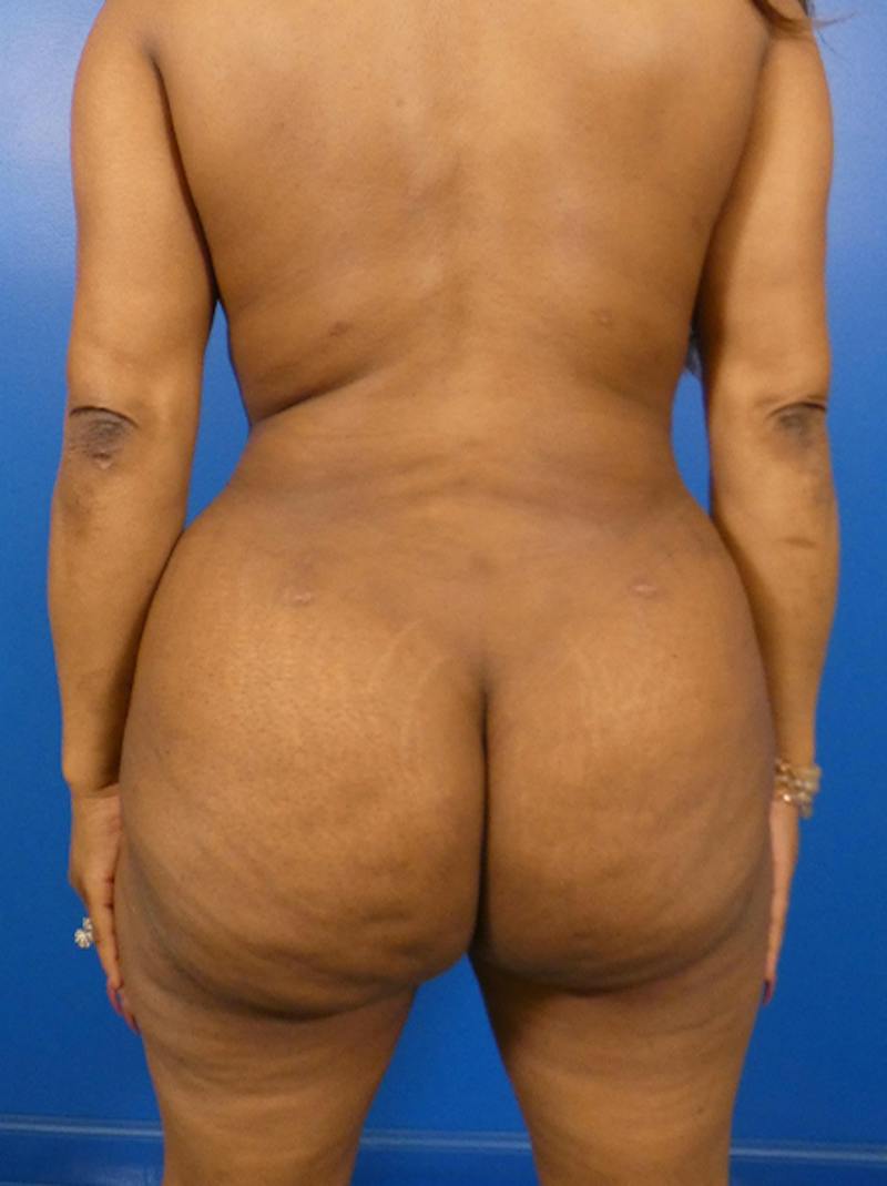 Liposuction Before & After Gallery - Patient 396376 - Image 2