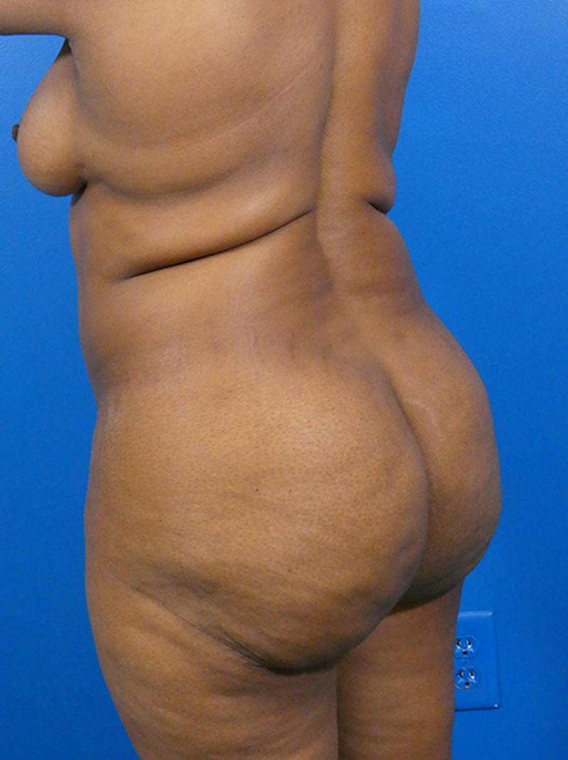 Liposuction Before & After Gallery - Patient 396376 - Image 3