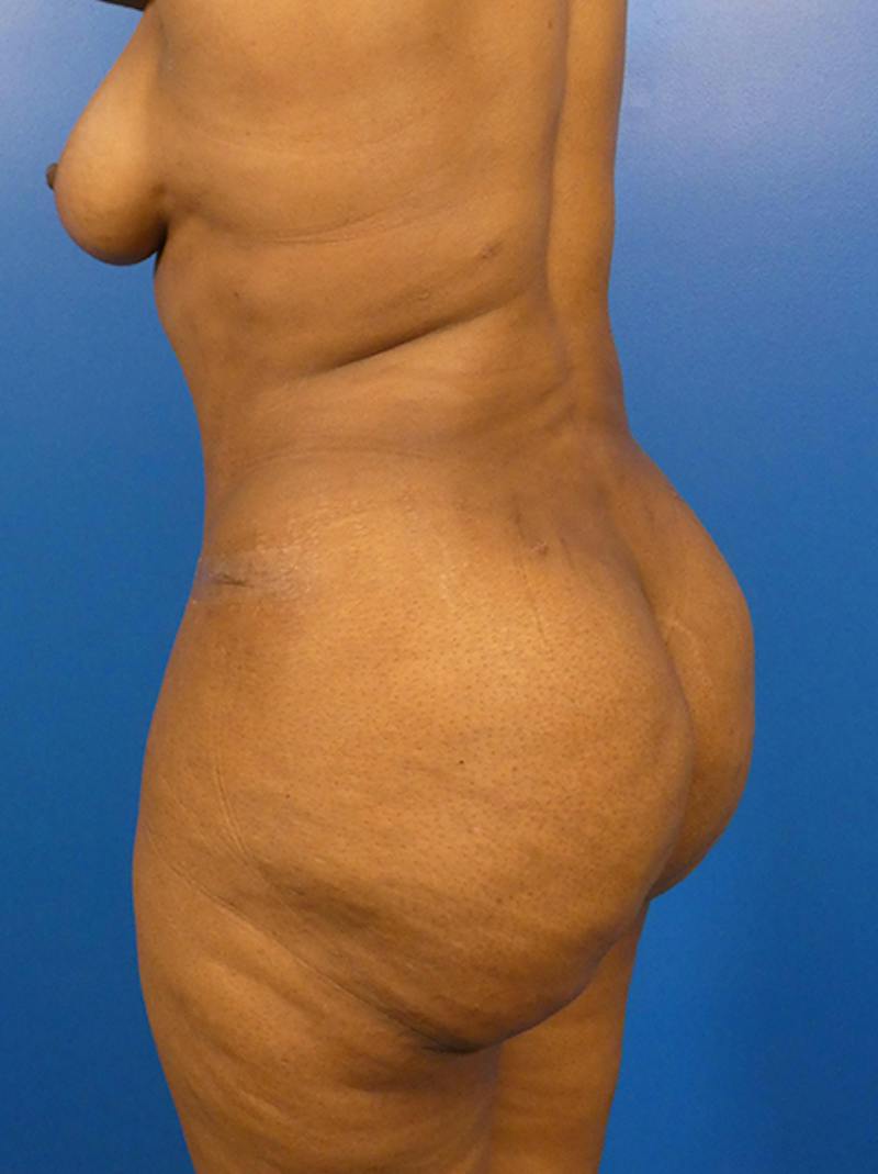 Liposuction Before & After Gallery - Patient 396376 - Image 4