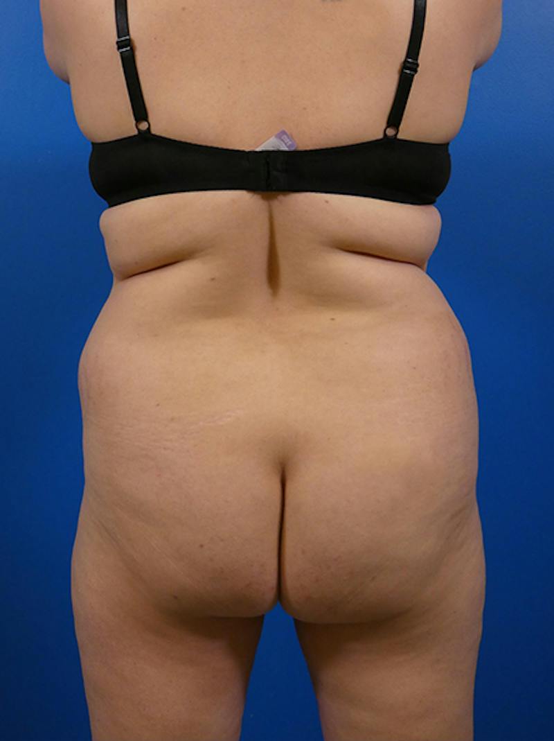 Liposuction Before & After Gallery - Patient 184214 - Image 1