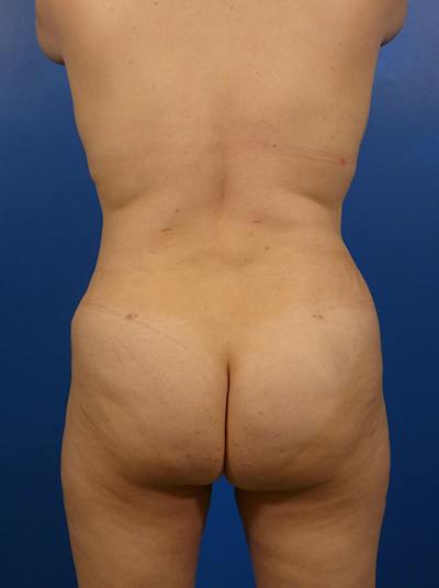 Liposuction Before & After Gallery - Patient 184214 - Image 2