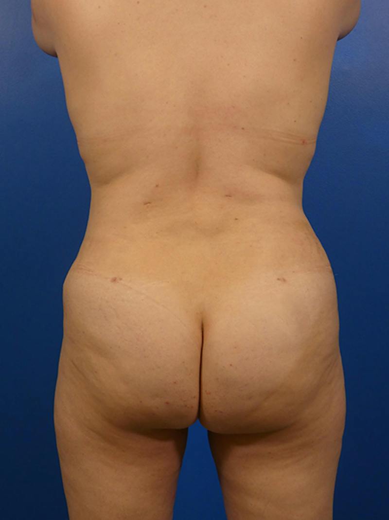 Liposuction Before & After Gallery - Patient 184214 - Image 2