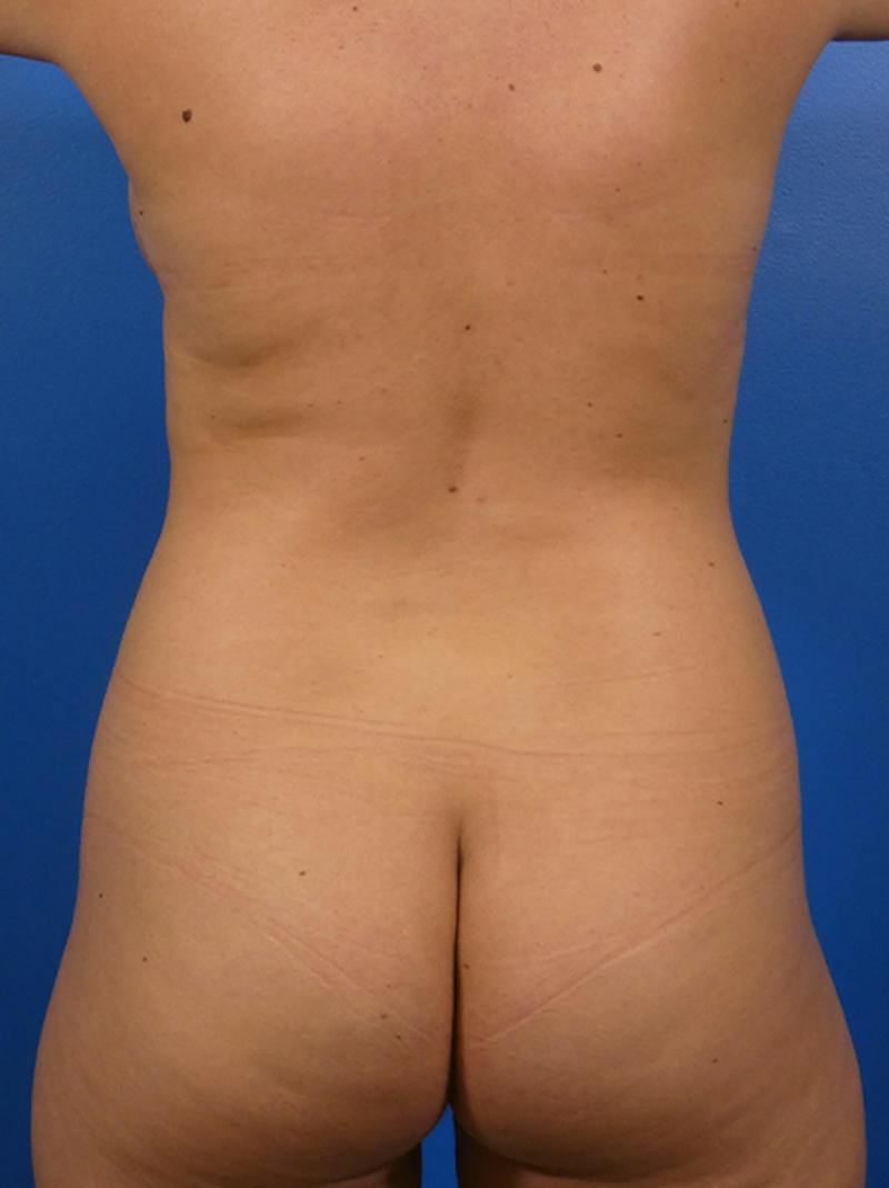 Liposuction Before & After Gallery - Patient 133938 - Image 5