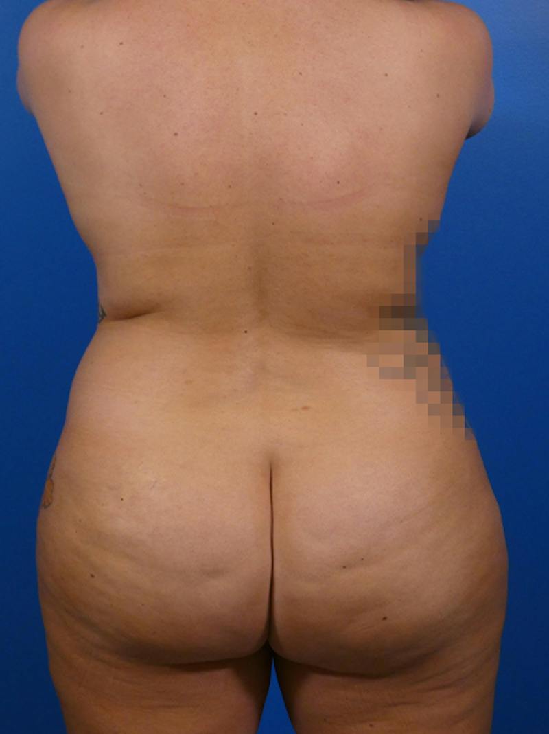 Liposuction Before & After Gallery - Patient 233905 - Image 3