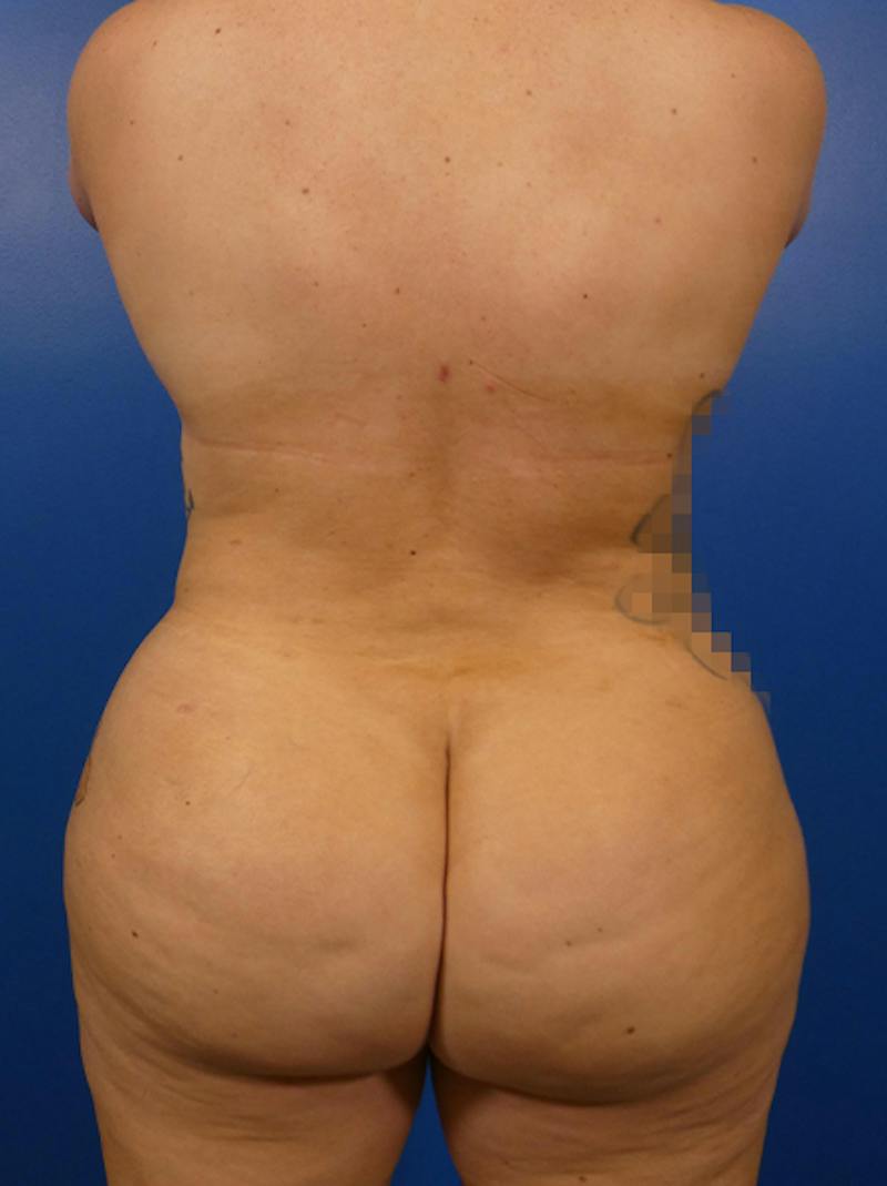 Liposuction Before & After Gallery - Patient 233905 - Image 4