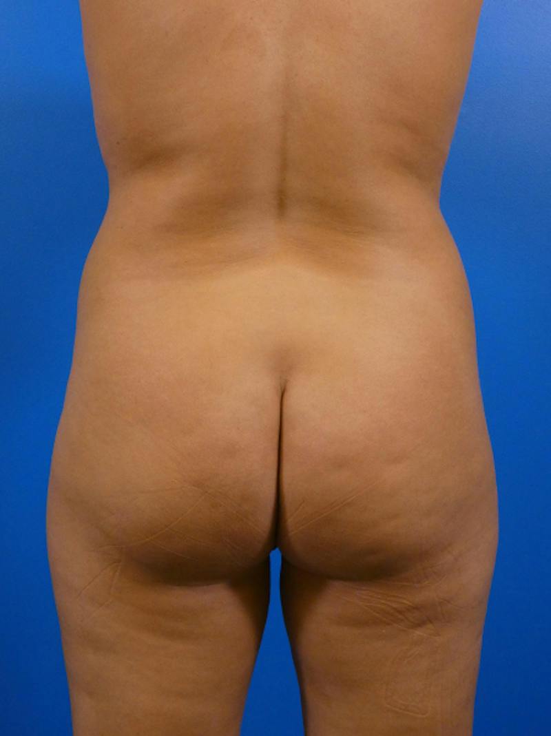 Liposuction Before & After Gallery - Patient 958324 - Image 1