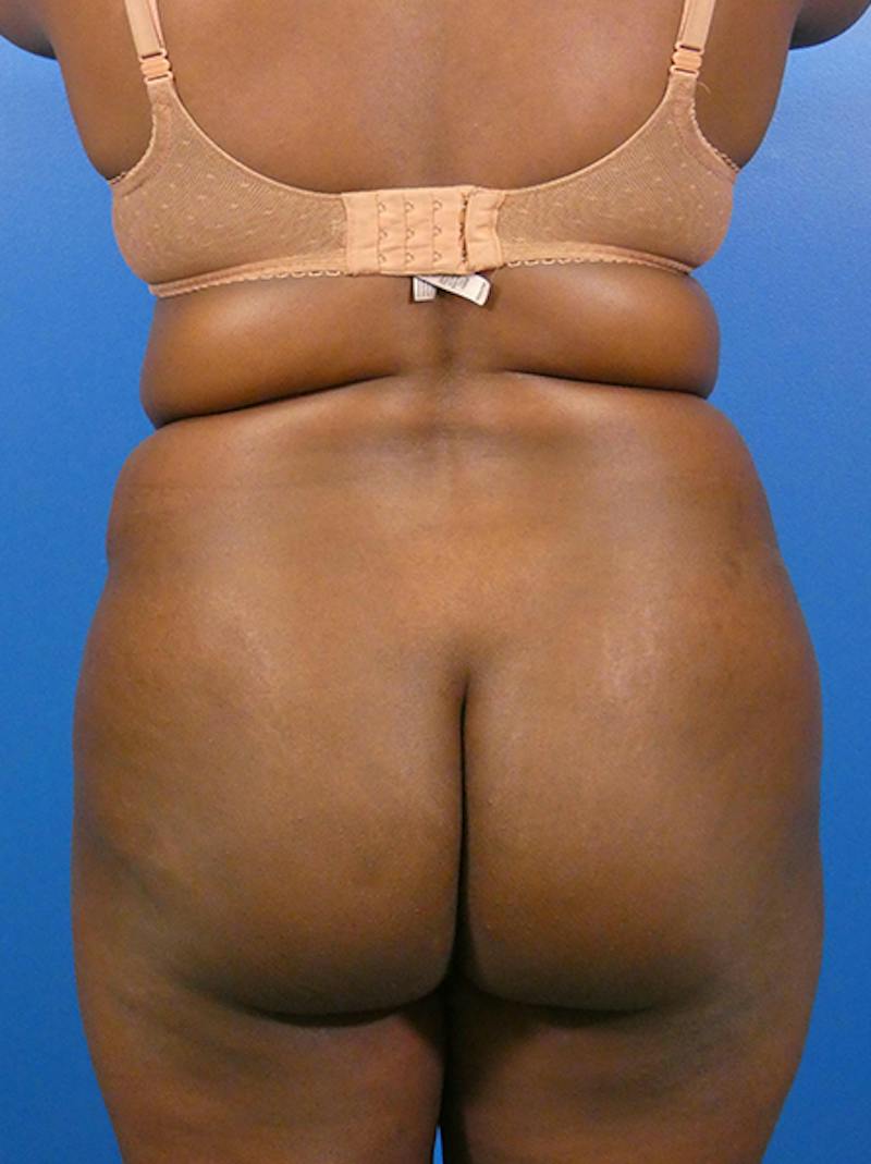 Liposuction Before & After Gallery - Patient 344444 - Image 1