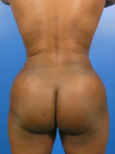 Liposuction Before & After Gallery - Patient 344444 - Image 2