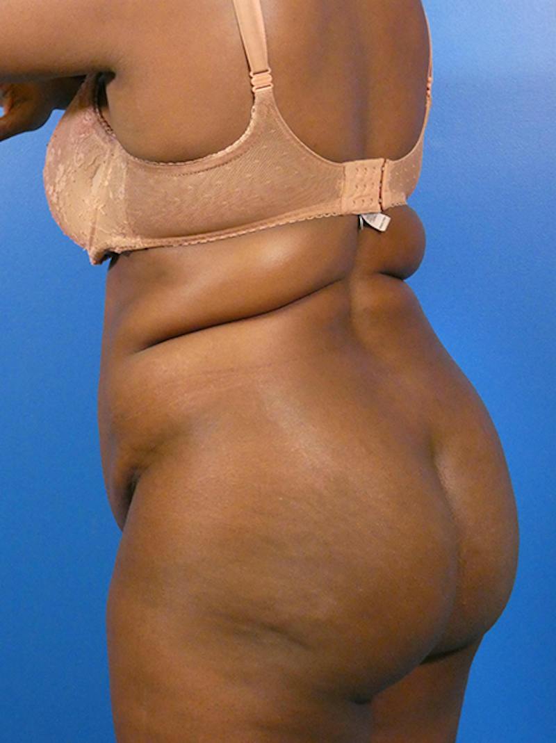Liposuction Before & After Gallery - Patient 344444 - Image 3