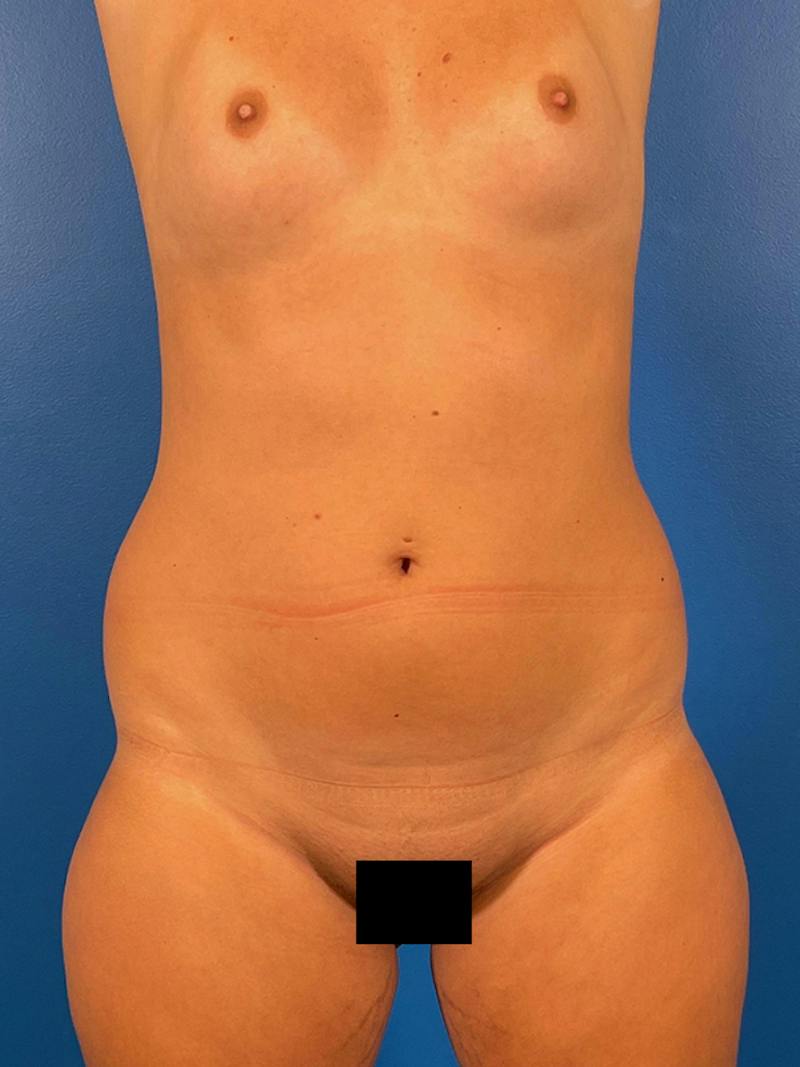 Liposuction Before & After Gallery - Patient 411831 - Image 1