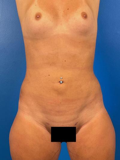 Liposuction Before & After Gallery - Patient 411831 - Image 2