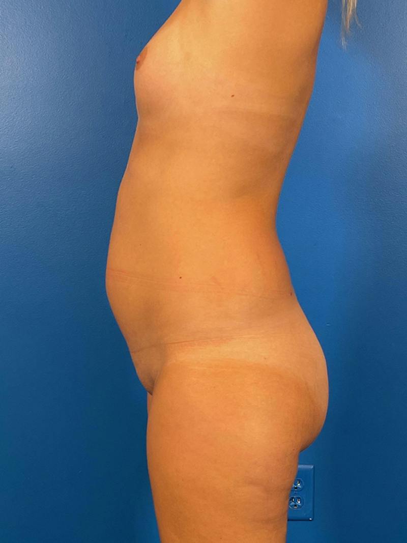 Liposuction Before & After Gallery - Patient 411831 - Image 3