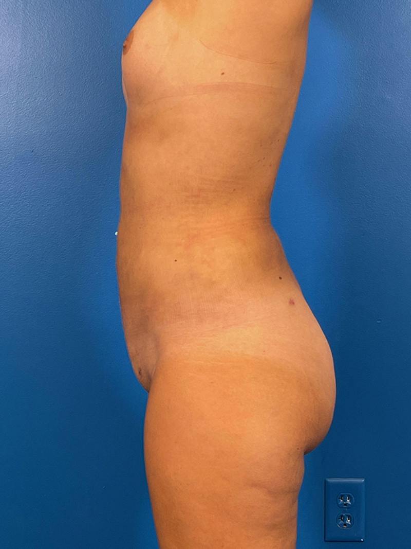 Liposuction Before & After Gallery - Patient 411831 - Image 4