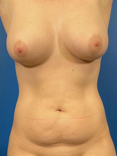 Liposuction Before & After Gallery - Patient 385112 - Image 1