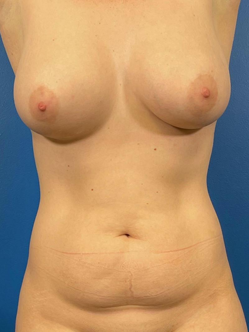 Liposuction Before & After Gallery - Patient 385112 - Image 1
