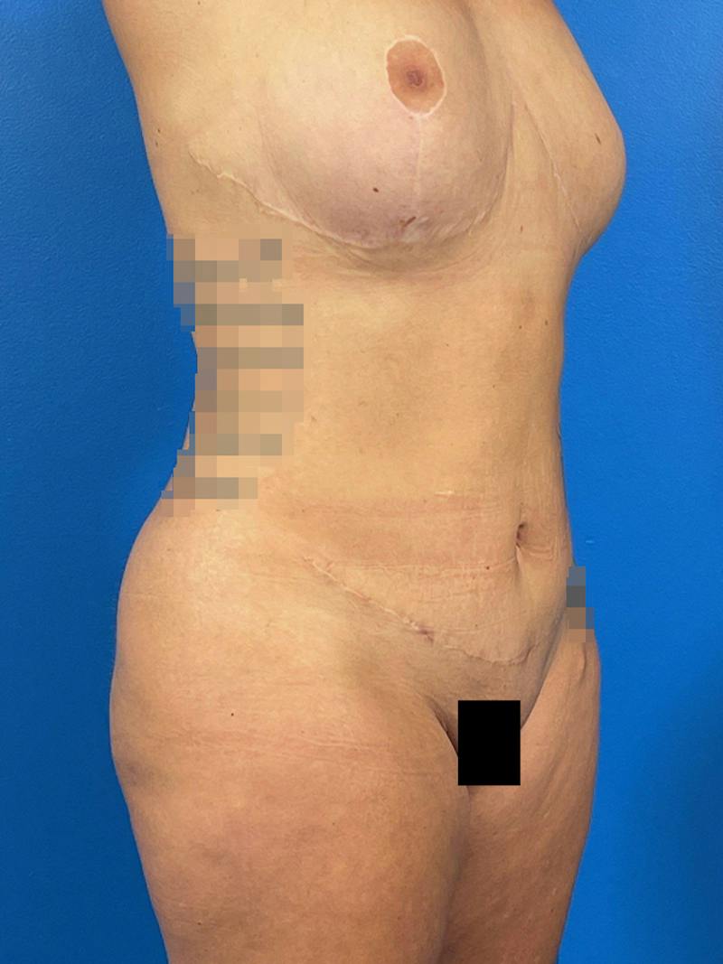 Liposuction Before & After Gallery - Patient 222218 - Image 4