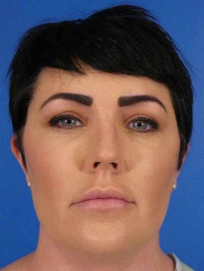 Liposuction Before & After Gallery - Patient 427117 - Image 1