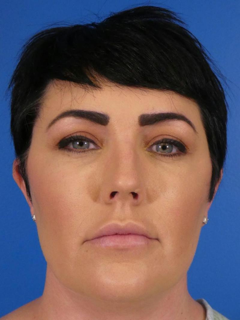 Liposuction Before & After Gallery - Patient 427117 - Image 1
