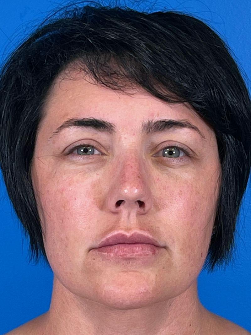 Liposuction Before & After Gallery - Patient 427117 - Image 2