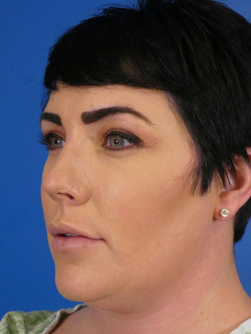 Liposuction Before & After Gallery - Patient 427117 - Image 3