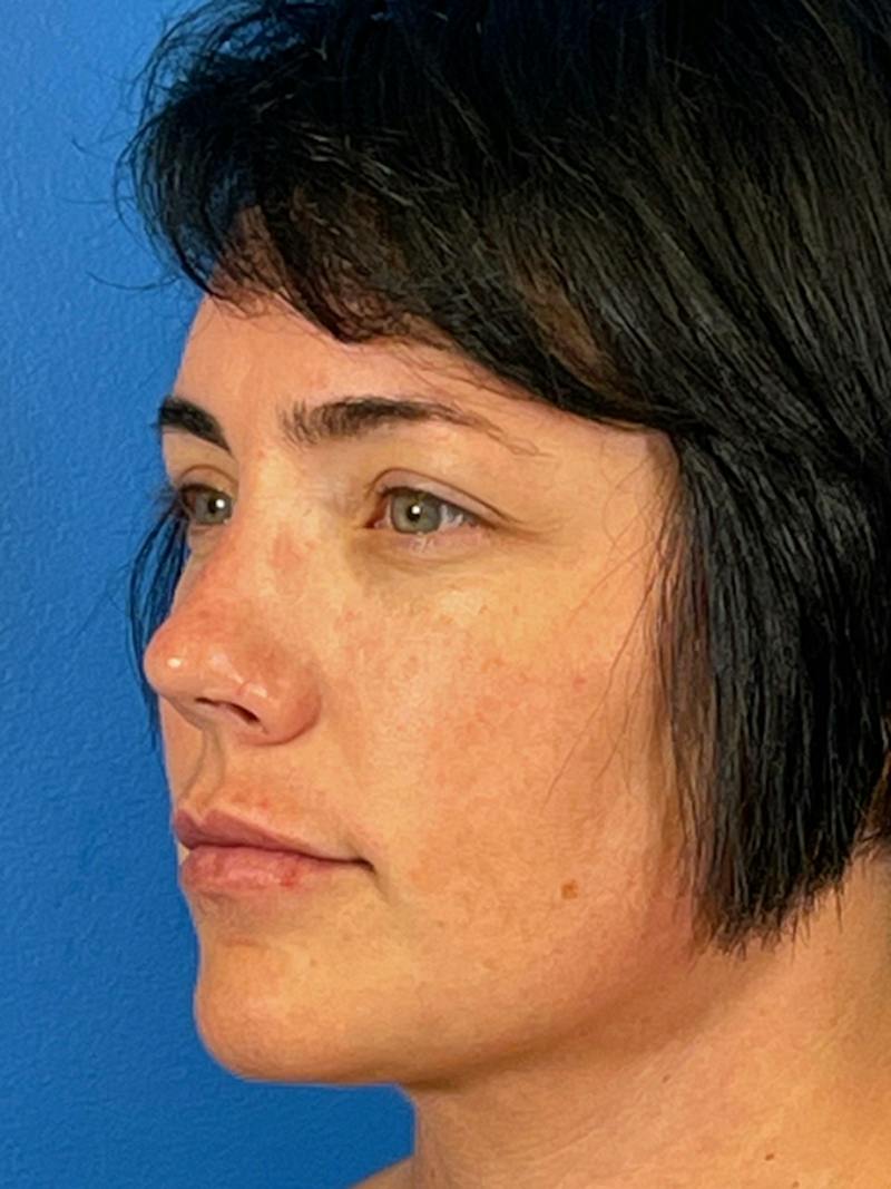 Liposuction Before & After Gallery - Patient 427117 - Image 4