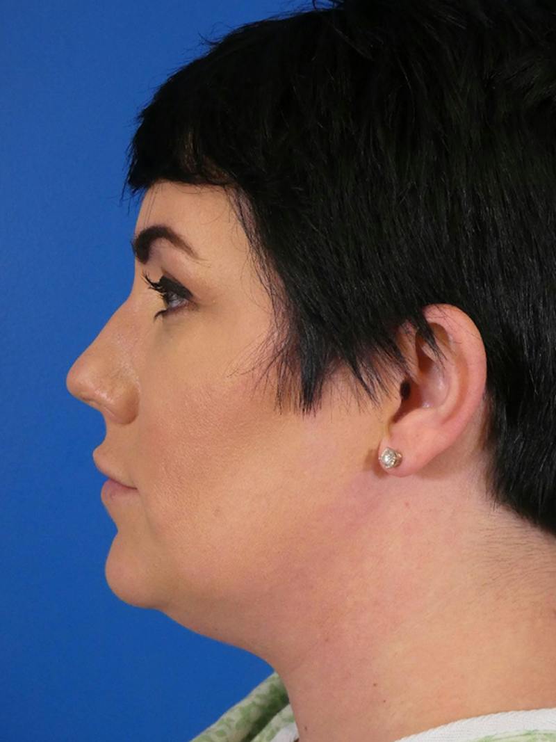 Liposuction Before & After Gallery - Patient 427117 - Image 5
